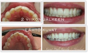 Inman Aligner raporttia